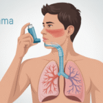 Ilustrasi penderita asma sedang menggunakan inhaler untuk mengatasi sesak napas