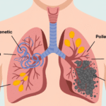 Ilustrasi penyebab asma menunjukkan faktor genetik dan lingkungan